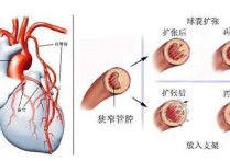 红缨医院治疗冠心病怎么样 北京治疗冠心病最好的医院是哪家?